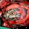 Exosquelette placé in vivo sur un cœur porcin